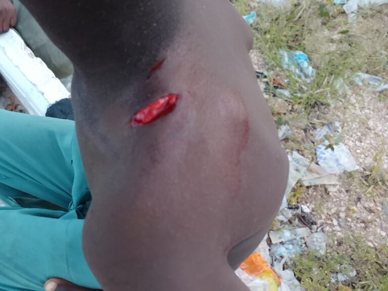 Rabies Scare in Kano Suspected Infected Dog Bites 18 People One of the Victim